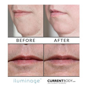 Before and After Hair Removal: iluminage Precise Touch